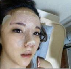 上海時(shí)光整形醫(yī)生何晉龍做假體隆鼻效果怎么樣？附案例效果對(duì)比圖