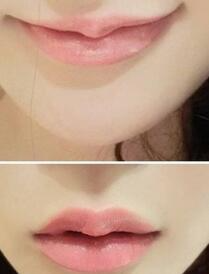巴中時(shí)光醫(yī)學(xué)美容門(mén)診部做玻尿酸豐唇效果怎么樣？附李紅強(qiáng)豐唇案例