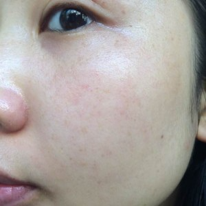 寶雞皮膚病醫(yī)院文東亮醫(yī)生做臉部祛斑效果怎么樣？附臉部祛斑案例