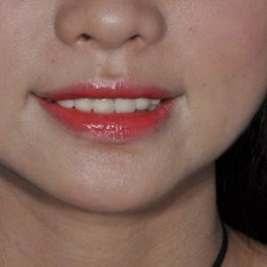 保定東陽(yáng)口腔醫(yī)院張亞靜醫(yī)生做牙齒冷光美白怎么樣？附冷光美白案例效果對(duì)比圖