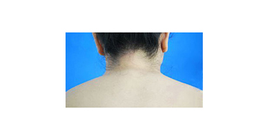 冷凍溶脂瘦肩膀術(shù)前