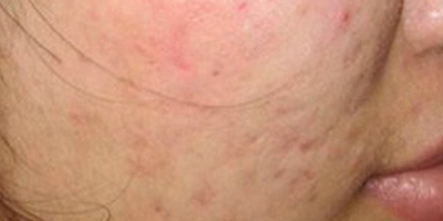 紅藍(lán)光祛痘術(shù)后